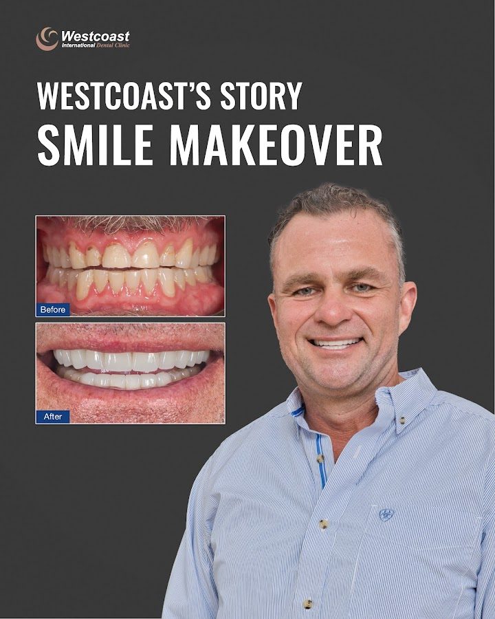 Smile makeover before and after at Westcoast International Dental